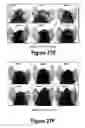 Fig. 17 - Molecular and Herbal Combinations for Treating Psoriasis