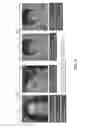 Fig. 18 - Injection paradigm for administration of botulinum toxins