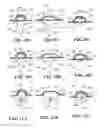 Fig. 13 - Methods and devices for applying closed incision negative pressure wound therapy