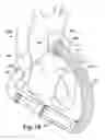 Fig. 12 - Blood pump