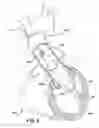 Fig. 17 - Blood pump