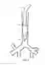 Fig. 03 - Endotracheal cuff and technique for using the same