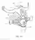 Fig. 54 - Heat and moisture exchanger for a patient interface