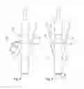 Fig. 04 - Ureteral Catheter Connector Adapter