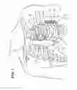 Fig. 02 - Collapsible extravascular lead