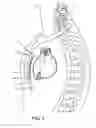 Fig. 03 - Collapsible extravascular lead