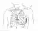 Fig. 01 - Systems and methods for deploying an implantable medical electrical lead
