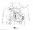 Fig. 02 - Systems and methods for deploying an implantable medical electrical lead