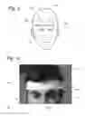 Fig. 05 - Transcutaneous neural stimulation device