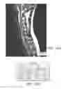Fig. 09 - EPIDURAL STIMULATION FOR FACILITATION OF LOCOMOTION, POSTURE, VOLUNTARY MOVEMENT, AND RECOVERY OF AUTONOMIC, SEXUAL, VASOMOTOR, AND COGNITIVE FUNCTION AFTER NEUROLOGICAL INJURY