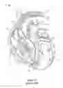 Fig. 16 - Leadless cardiac stimulation systems