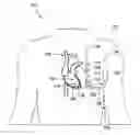 Fig. 01 - SYSTEMS AND METHODS FOR MANAGING TIERED TACHYCARDIA THERAPY