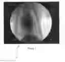 Fig. 02 - Registration of fluoroscopic images of the chest and corresponding 3D image data based on the ribs and spine