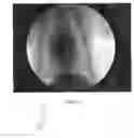 Fig. 04 - Registration of fluoroscopic images of the chest and corresponding 3D image data based on the ribs and spine