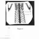 Fig. 06 - Registration of fluoroscopic images of the chest and corresponding 3D image data based on the ribs and spine