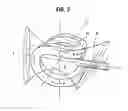 Fig. 04 - Magnetic Torsion Accelerator