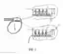 Fig. 09 - Interconnect for implantable medical device header