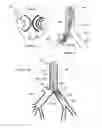 Fig. 02 - Endobronchial tube with integrated image sensor