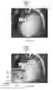 Fig. 06 - Magnification in ophthalmic procedures and associated devices, systems, and methods