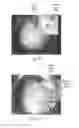 Fig. 10 - Magnification in ophthalmic procedures and associated devices, systems, and methods