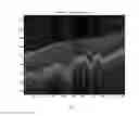 Fig. 06 - Systems and methods for automated classification of abnormalities in optical coherence tomography images of the eye
