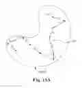 Fig. 12 - Methods, devices and systems for sensing, measuring and/or characterizing vessel and/or lesion compliance and/or elastance changes during vascular procedures