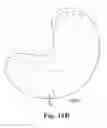 Fig. 13 - Methods, devices and systems for sensing, measuring and/or characterizing vessel and/or lesion compliance and/or elastance changes during vascular procedures