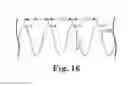 Fig. 14 - Methods, devices and systems for sensing, measuring and/or characterizing vessel and/or lesion compliance and/or elastance changes during vascular procedures