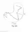 Fig. 12 - METHODS, DEVICES AND SYSTEMS FOR SENSING, MEASURING AND/OR CHARACTERIZING VESSEL AND/OR LESION COMPLIANCE AND/OR ELASTANCE CHANGES DURING VASCULAR PROCEDURES