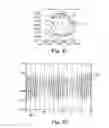 Fig. 20 - METHODS, DEVICES AND SYSTEMS FOR SENSING, MEASURING AND/OR CHARACTERIZING VESSEL AND/OR LESION COMPLIANCE AND/OR ELASTANCE CHANGES DURING VASCULAR PROCEDURES