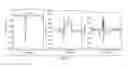 Fig. 07 - Method and apparatus for comparing and visualizing serial ECG data