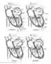 Fig. 07 - Orientation device for use in mitral valve repair