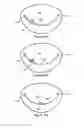 Fig. 16 - Orientation device for use in mitral valve repair