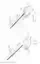 Fig. 45 - Pneumoperitoneum device