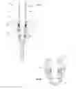 Fig. 06 - Spondylolisthesis reduction system