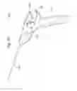 Fig. 15 - Suture clip deployment devices