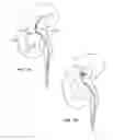 Fig. 05 - METHODS AND SYSTEMS FOR REMOVING TISSUE FROM BODY CAVITIES