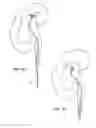 Fig. 06 - METHODS AND SYSTEMS FOR REMOVING TISSUE FROM BODY CAVITIES
