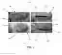 Fig. 02 - Devices and methods for anterior arytenoid adduction