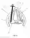 Fig. 07 - Devices and methods for anterior arytenoid adduction