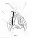 Fig. 08 - Devices and methods for anterior arytenoid adduction