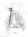 Fig. 10 - Devices and methods for anterior arytenoid adduction