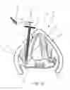 Fig. 11 - Devices and methods for anterior arytenoid adduction