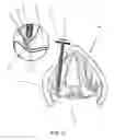 Fig. 12 - Devices and methods for anterior arytenoid adduction