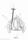 Fig. 13 - Devices and methods for anterior arytenoid adduction