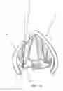 Fig. 14 - Devices and methods for anterior arytenoid adduction