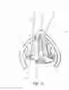 Fig. 16 - Devices and methods for anterior arytenoid adduction