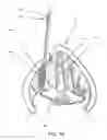 Fig. 17 - Devices and methods for anterior arytenoid adduction