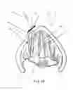 Fig. 19 - Devices and methods for anterior arytenoid adduction