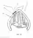 Fig. 20 - Devices and methods for anterior arytenoid adduction
